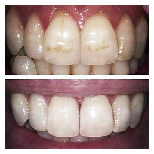Smartbleach 3lt teeth whitening